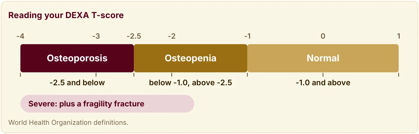 Scale of DEXA T-scores from -4 to 1: osteoporosis at -2.5 and below, osteopenia between -1.0 and -2.5, normal at -1.0 and above.